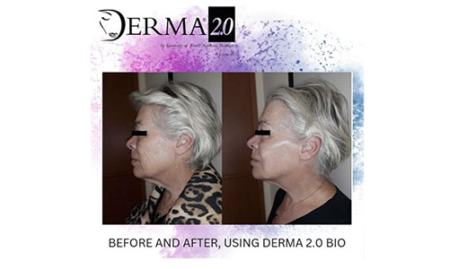 Derma 2.0 Bio Skin Booster Facial Treatment Glasgow