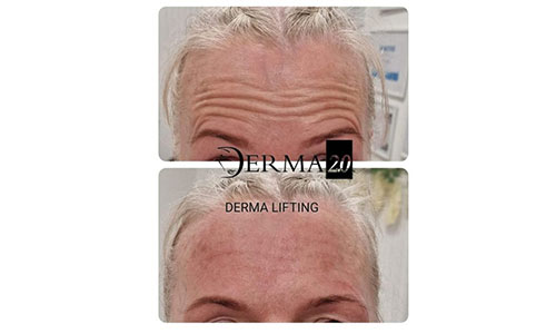 Derma 2.0 Lifting Skin Booster Facial Treatment Glasgow