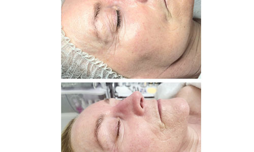 Glow Chemical Peel Facial Treatment Glasgow