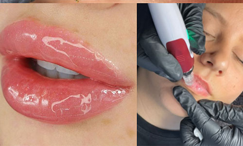 Hydra Gloss Lips Facial Treatment Glasgow