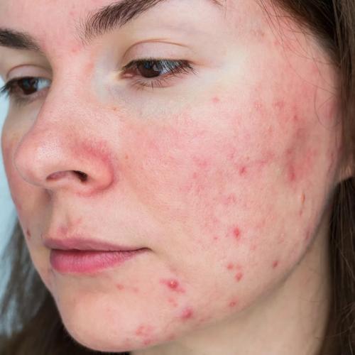 How do breakouts occur and what to do about them?